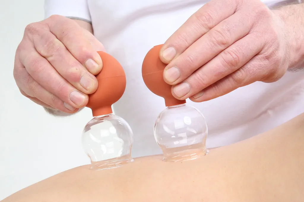 masaje con ventosas (cupping)